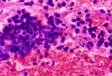 Lung cancer epithelial