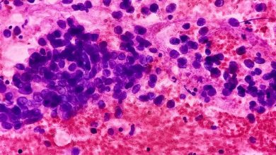 Lung cancer epithelial