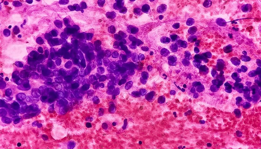 Lung cancer epithelial